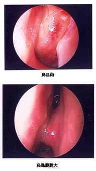 首大刘玉梅 鼻子里长息肉是怎么回事 不做手术行不行