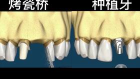 医生为什么建议做种植牙 看看种植牙跟烤瓷牙有什么区别吧