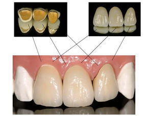 金鈀烤瓷牙價格貴金屬烤瓷牙的價格