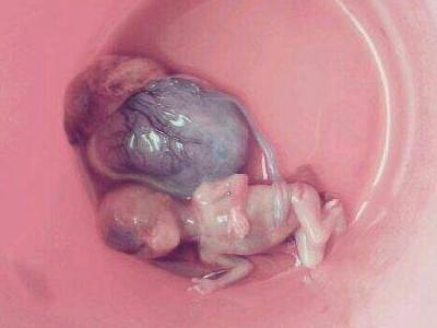 胎儿也是生命,堕胎是会有报应的,震撼