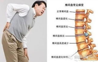 腰间盘突出可以按摩吗(椎间盘4—5突出最佳治疗)