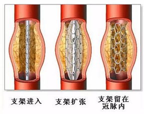 心脏支架后能打乒乓球吗(心脏支架后能打乒乓球吗有影响吗)