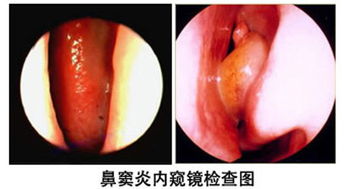 鼻窦炎的最佳治疗方法 