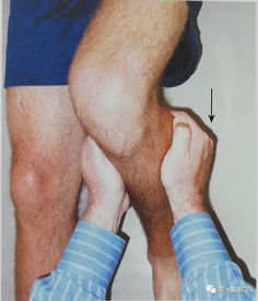 八种引起膝关节的疼痛综合征Ⅰ