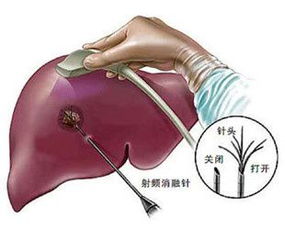 肝癌治疗的最新方法