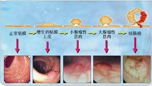 前年肠镜没事,今年就查出结肠癌 肠镜究竟多久做一次保险