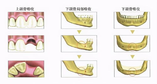 庄医生 为什么有些人做种植牙之前需要植骨 不植骨会产生什么问题