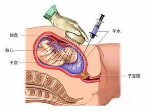 羊水穿刺吓倒一大片孕妈 它究竟是干什么用的 