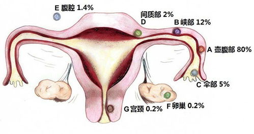 宫外孕早期症状(宫外孕早期症状有哪些)