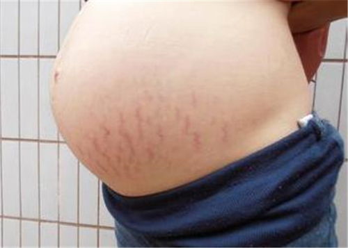 原创孕妈在孕期有这些表现，那就偷着乐吧，说明你不容易长妊娠纹