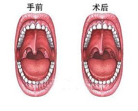 在什么情况下，扁桃体要切除