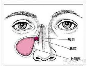 鼻窦炎患者隆哪种鼻子最佳效果好