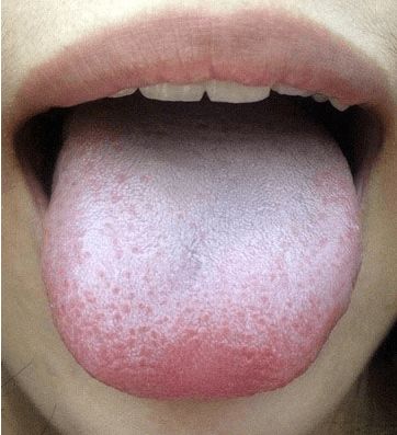 舌苔发白怎么回事
