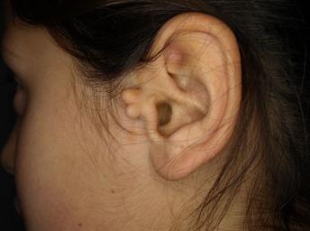 什么是附耳 治疗这种耳部问题可以这样做