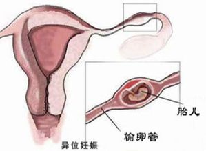 输卵管妊娠 什么是输卵管妊娠