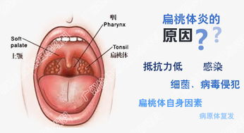 慢性扁桃体炎的治疗 