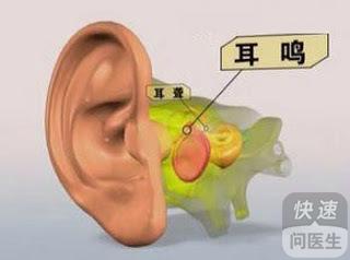 耳鸣 耳鸣是什么原因引起的,怎么根治