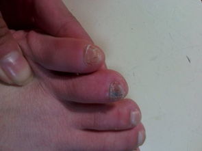 为什么我脚趾里面有黑丝一样的东西,在里面 还有我的小脚趾怎么会变成这样 
