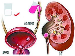 尿道结石忌口 尿结石的食疗方